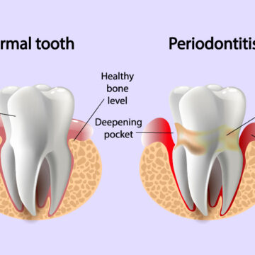 Unveiling the Secrets of Periodontics: Your Comprehensive Guide to Gum Health, Treatment, and Prevention Strategies
